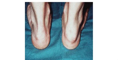 Enthesitis Of The Achilles Tendon Of A Patient With Psoriatic Arthritis