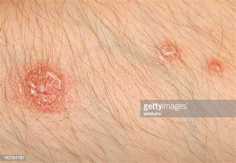Psoriasis Elbows Photos And Premium High Res Pictures Getty Images