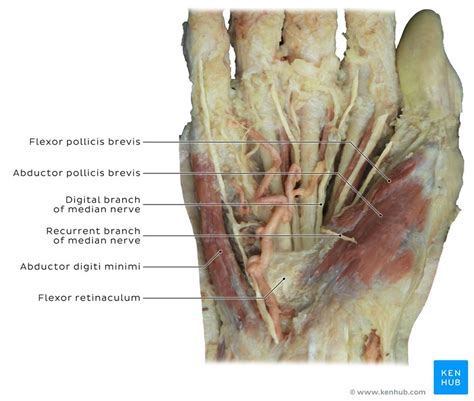 Related online courses on physioplus. Glomus tumor mimicking a carpal tunnel syndrome | Kenhub