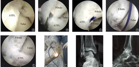 Arthroscopic Anatomical Repair Of Anterior Talofibular Ligament For