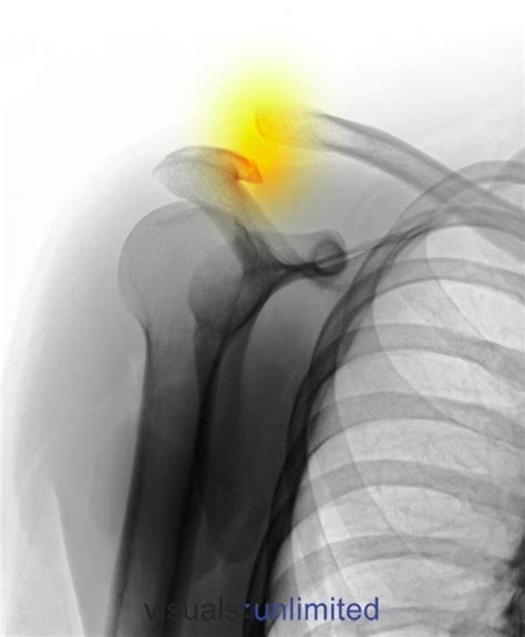 Colorized X Ray Showing An Acromioclavicular Separation Of The Shoulder