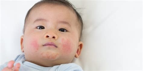 Baby Eczema What You Need To Know About Tending To Babys Skin