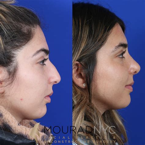 Female Rhinoplasty 4 Month Before And After Head And Neck Surgeon