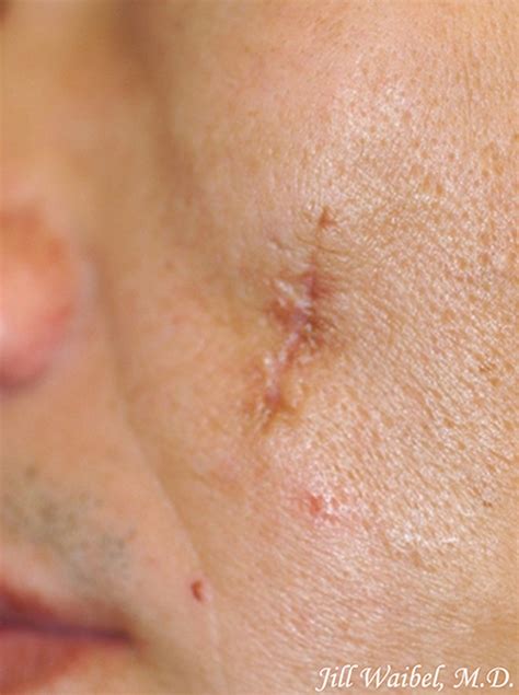 Surgical Scars Before And After Pictures In Miami Fl Miami