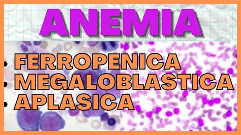 Anemia Ferropenica Megaloblastica Y Aplasica Fisiopatologia Youtube