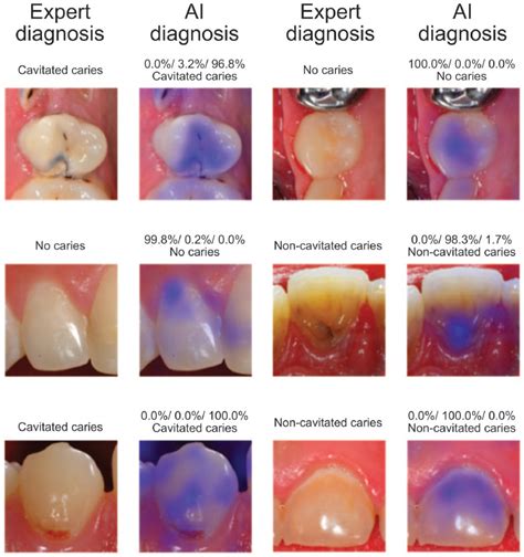 Caries Detection On Intraoral Images Using Artificial Intelligence J