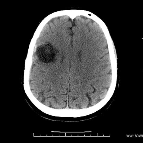 Brain Ct Showing Cerebral Abscess Of The Frontparietal Region