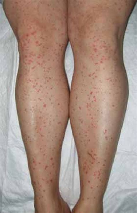 Erythematous Purple Papules On The Lower Legs Download Scientific