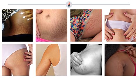 Stretch Marks All You Need To Know Guide Elara Care
