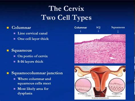 Womens Health Pap Smear And Cervical Dysplasia Youtube