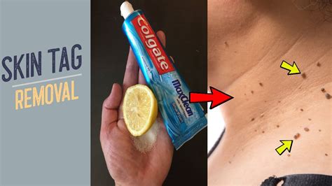 remove skin tags overnight with colgate how to remove skin tag skin tag removal youtube
