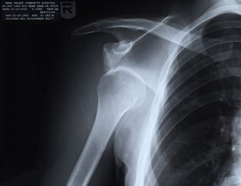 Dislocated Shoulder X Ray Old Injury X Ray From 121203 Flickr