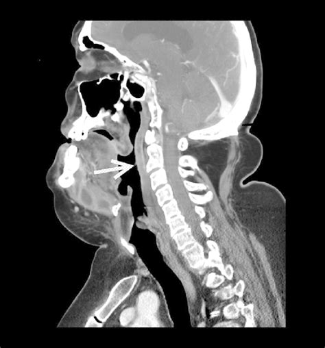 Ct Examination Of Head And Neck Sagittal Scan Soft Tissue Window