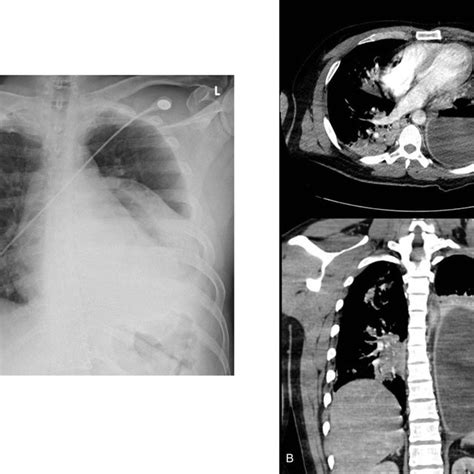 The Follow Up Chest X Ray Showing An Improvement Of The Lung Abscess In