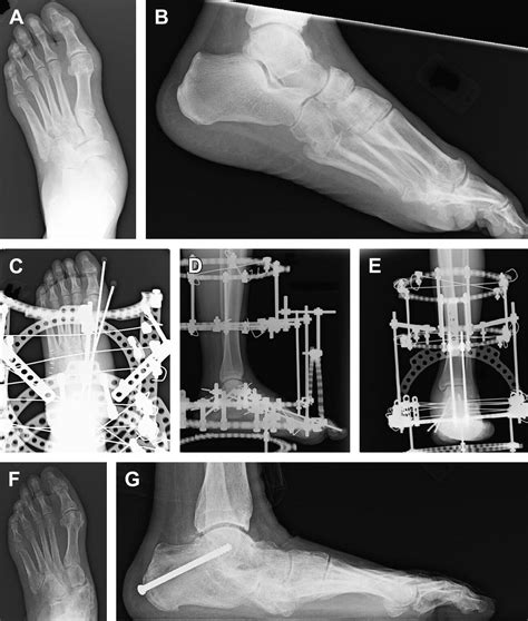 Surgical Reconstruction Of The Diabetic Charcot Foot Clinics In