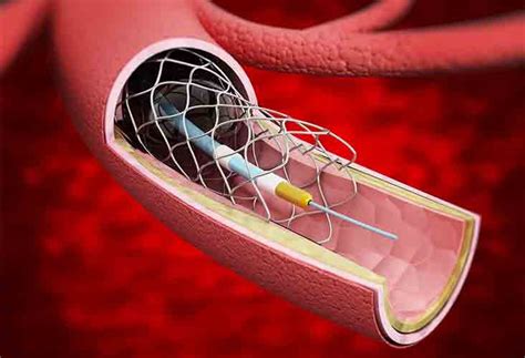 Overuse Of Stents And Bypass Surgery In Heart Cases Reported Edta