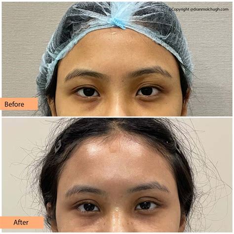 Eyelid Surgery In Gurgaon Blepharoplasty In Delhi Ncr India
