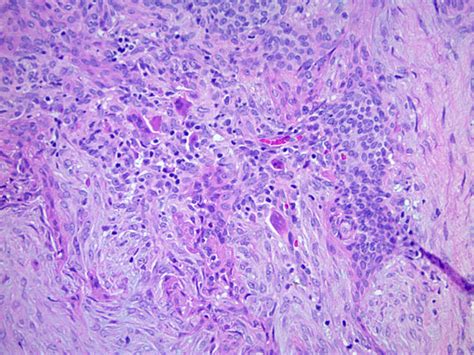 Pathology Outlines Cutaneous Mixed Tumor Chondroid Syringoma
