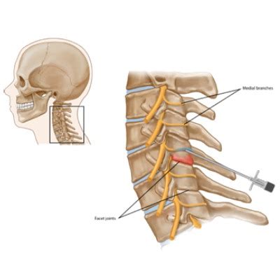 Cervical Facet Joint Syndrome Alleviatepainclinic