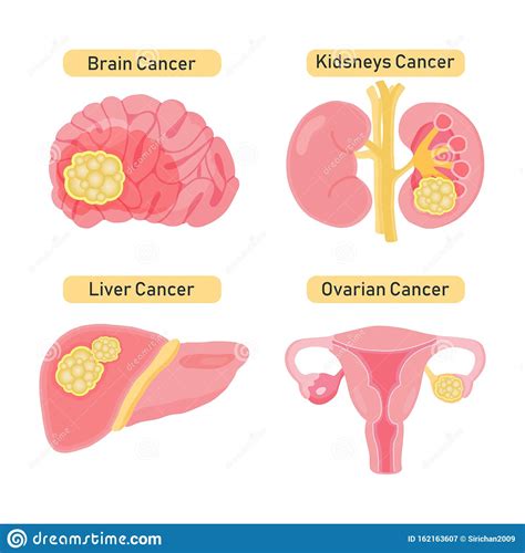 Cancer Types Flat Illustration Stock Illustration Illustration Of
