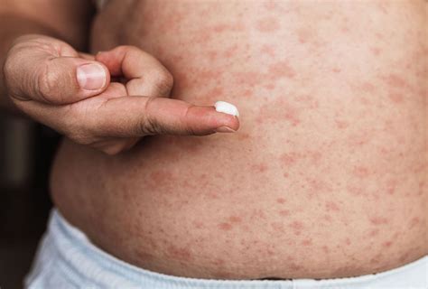 Contact Dermatitis Treatment And Management