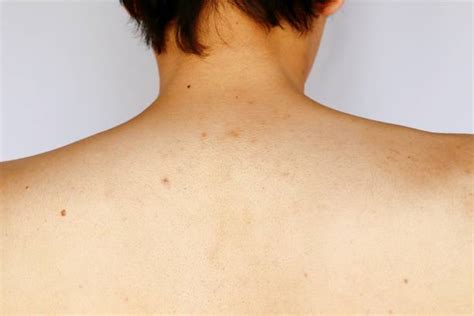 110 Acne On A Males Shoulder Stock Photos Pictures And Royalty Free