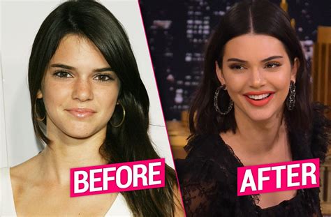 Kendall Jenner S Plastic Surgery Exposed By Top Docs