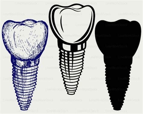 Tooth Implant Svgtooth Implant Clipartimplant Svgtooth Etsy