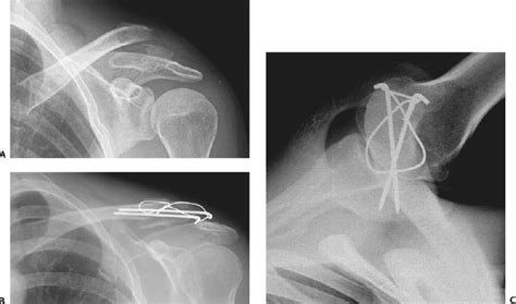 Operative Treatment Of Fractures Of The Clavicle Musculoskeletal Key