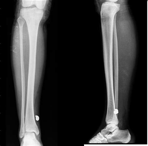 Rayos X Una Radiografía De La Tibia Y El Peroné Es Un