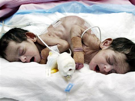 Conjoined Twins 40 Amazing Photos Graphic Images Photo 17