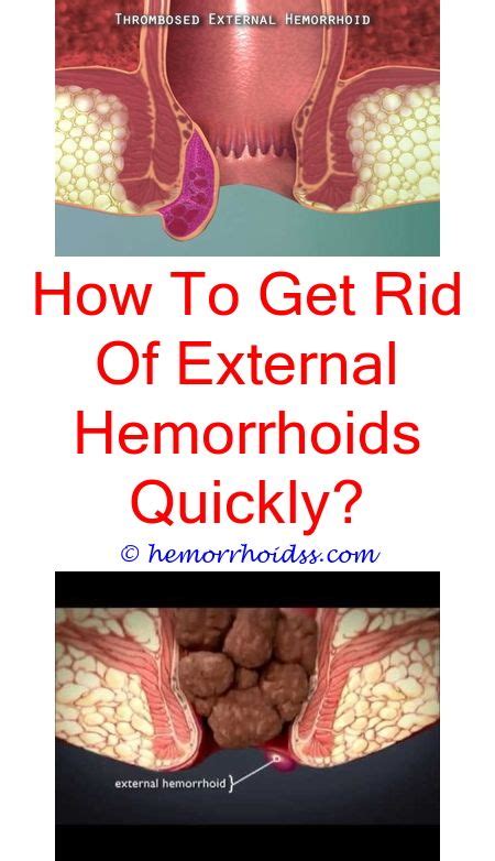 Mind Blowing Ideas Can Hemorrhoids Cause Weak Urine Flow Can A
