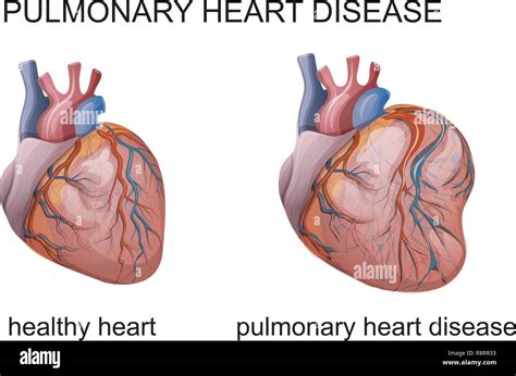 Vector Illustration Of Pulmonary Heart Disease Cardiology Stock Vector