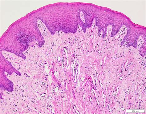 Pathology Outlines Irritation Fibroma