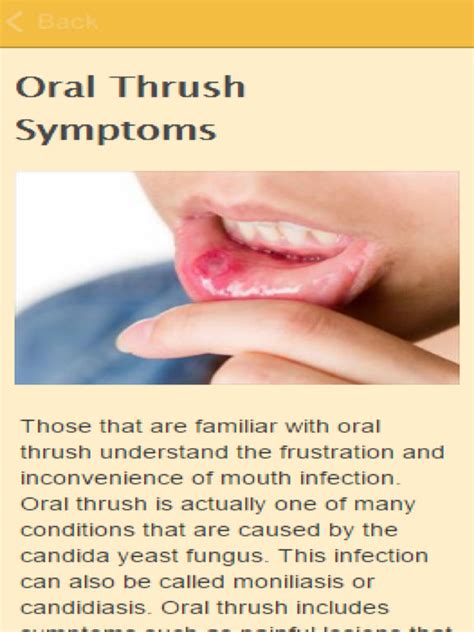 What Can I Use For Oral Thrush Oral Thrush In Adults Nhs Inform