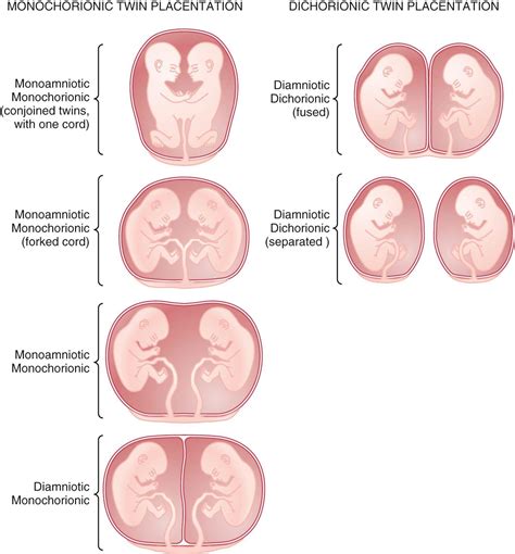 Multifetal Gestation And Malpresentation Clinical Tree