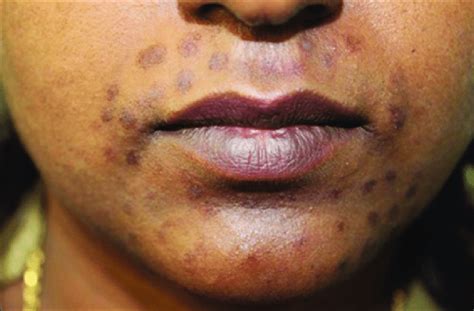 Postinflammatory Hyperpigmentation After Diode Laser For Hair Removal