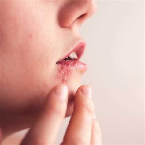 All About Oral Herpes Forces Of Nature Medicine