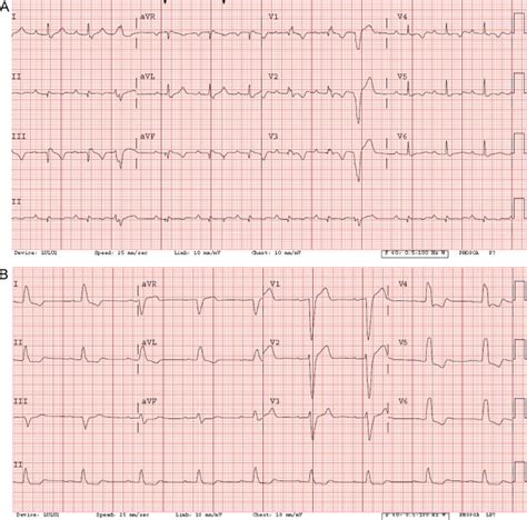 Evaluation And Management Of Heart Rhythm Disturbances Due To Cardiac