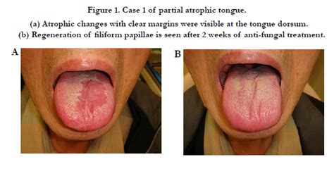 Clinical Features Of Partial Atrophic Tongue Associated With Candida