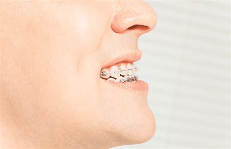 Overbite Vs Underbite Whats The Difference And Treatments