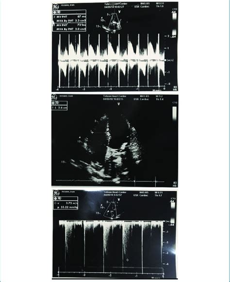 Echocardiography After Mitral Valve Replacement With A St Jude