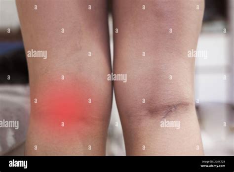 Varicose Veins Leg And Foot High Resolution Stock Photography And