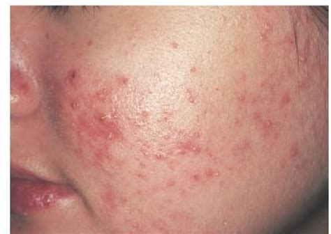 Acne Vulgaris And Related Disorders Part 1