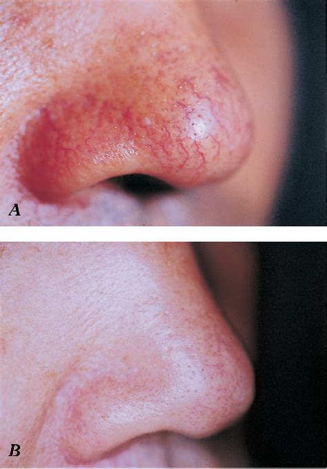 A Simple Technique For Treatment Of Nasal Telangiectasia Using