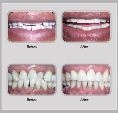 Straighten teeth without braces fundamentals explained. Smile Gallery, before and after images - Lakeway Dentist ...