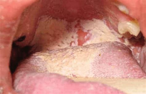 White Spots On Tonsils And How To Get Rid Of Them
