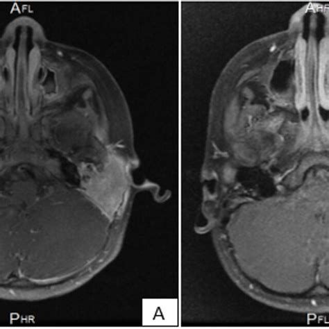 Axial View Of Post Contrasted T1 Mri Images A The Image Shows The