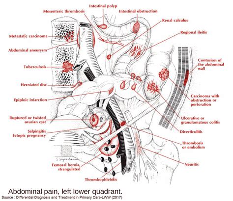 Lower Abdominal Pain In The Emergency Department Manual Of Medicine