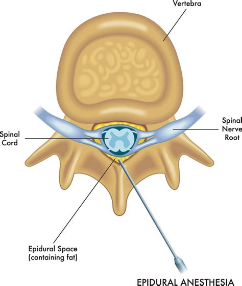 Ask Dr John Esq What Are Epidural Steroid Injections Diller Law